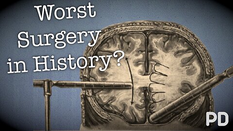 The Dark side of Science: The Lobotomy, the worst surgery in history-Documentary