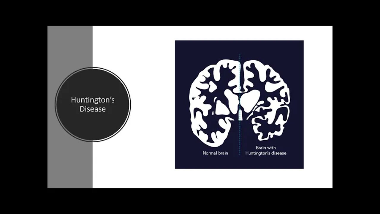 Huntingtons Disease - Natural/Alternative Treatment Options