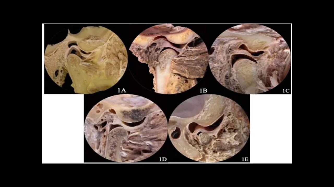 Oral medicine L6 Part1 (Temporomandibular Joint “TMJ”)