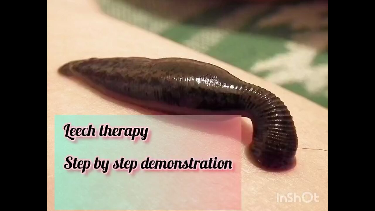 Leech Therapy