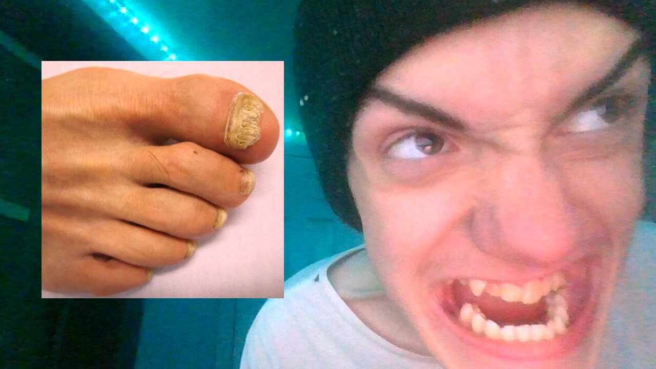 Yummy Delicious TOE FUNGUS Videos On The INTERNET!!!