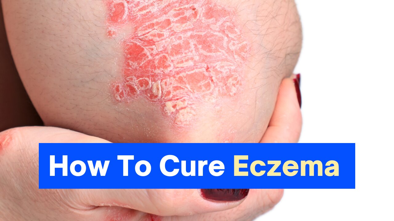 Cure Eczema at home