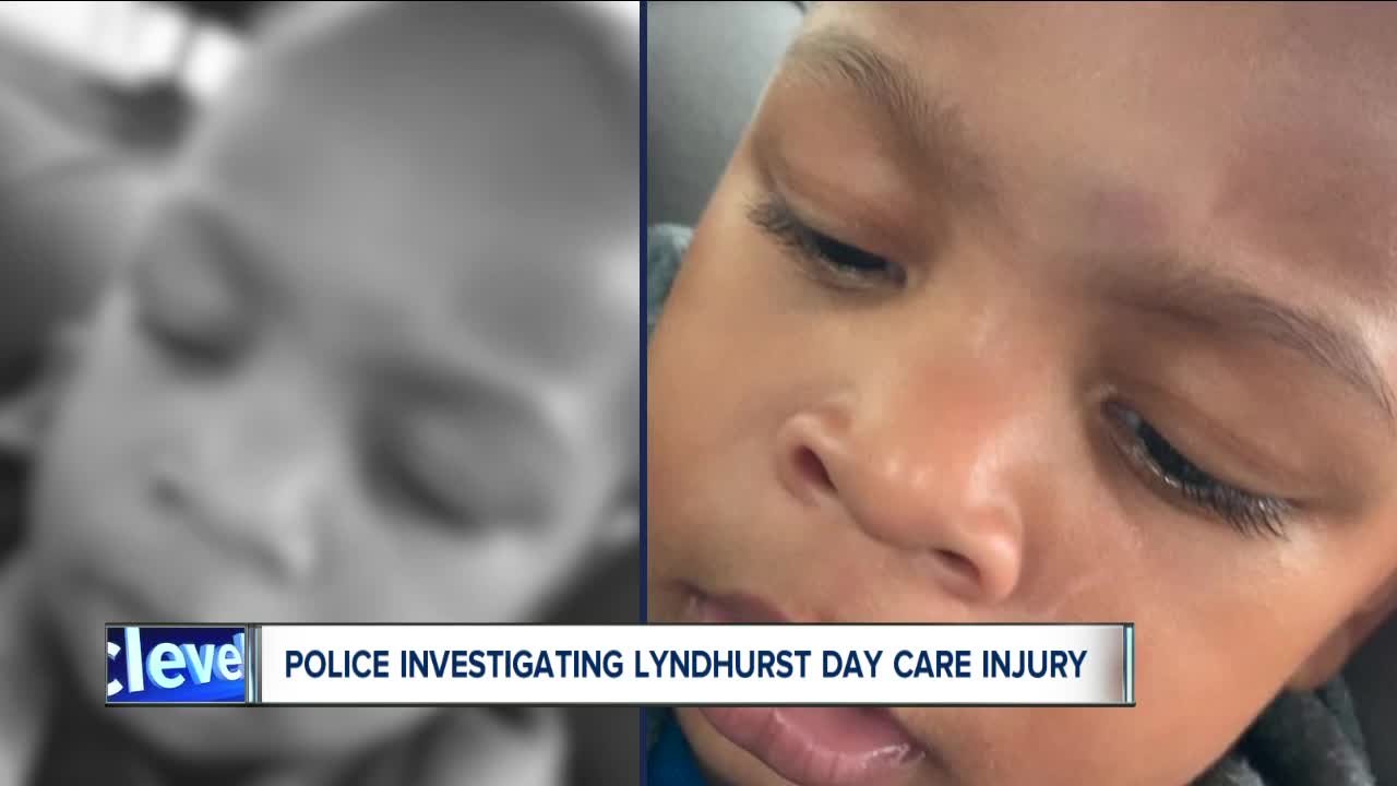 Lyndhurst police issue warrant for former daycare worker after toddler came home with bruise on head