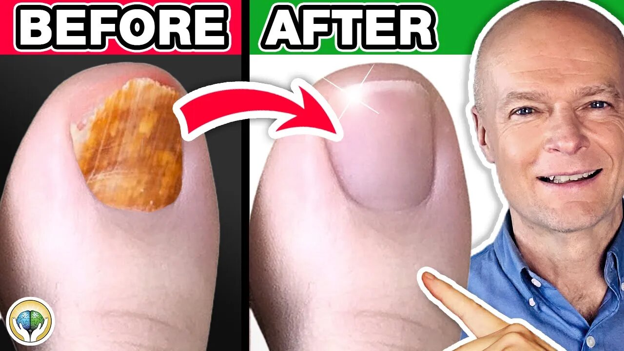 #1 Absolute Best Toenail Fungus Cure