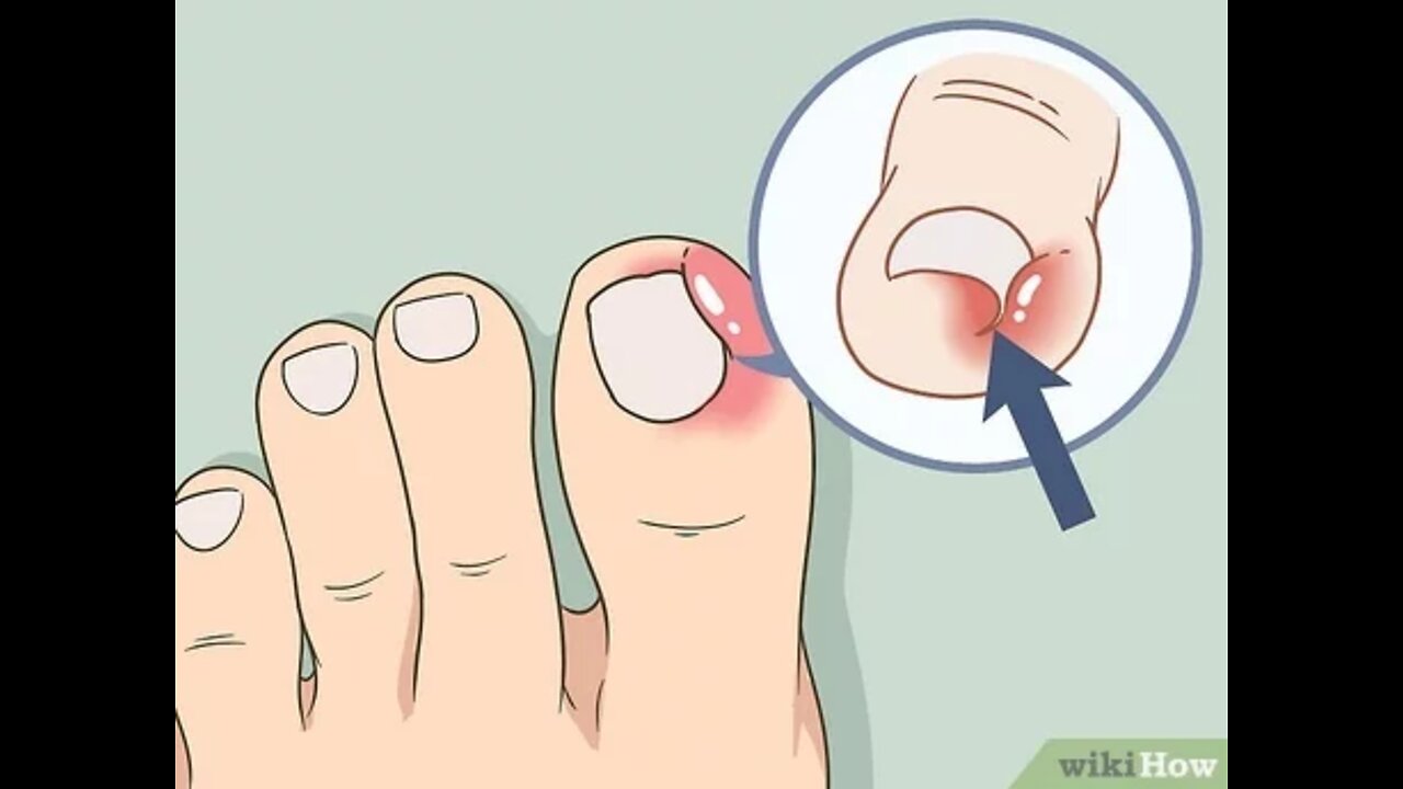 Ingrowing Toenail removal animation