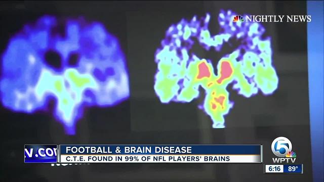 Reactions to new study on brain disease linked to football injuries