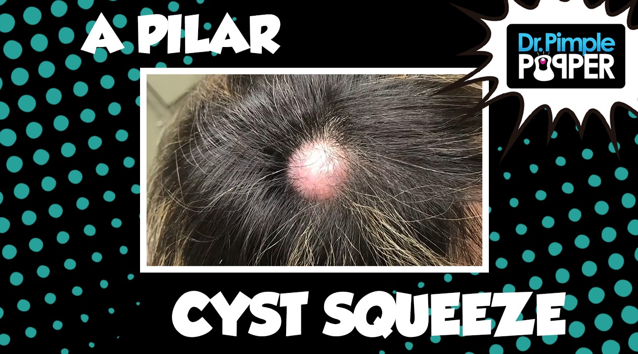 Don't Be Cyst Averse...Embrace the Popping