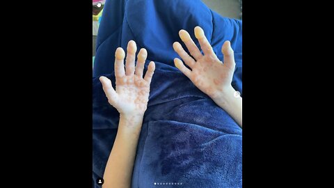 תופעת לוואי ילד בן 12 יבלות חמורות בכל הגוף