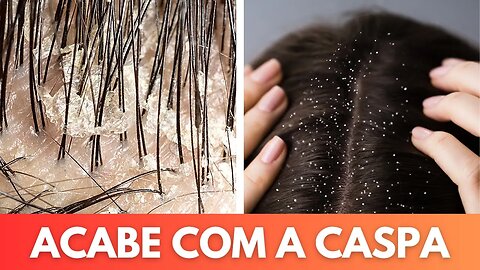 Os melhores truques naturais para dizer adeus à caspa de uma vez por todas!