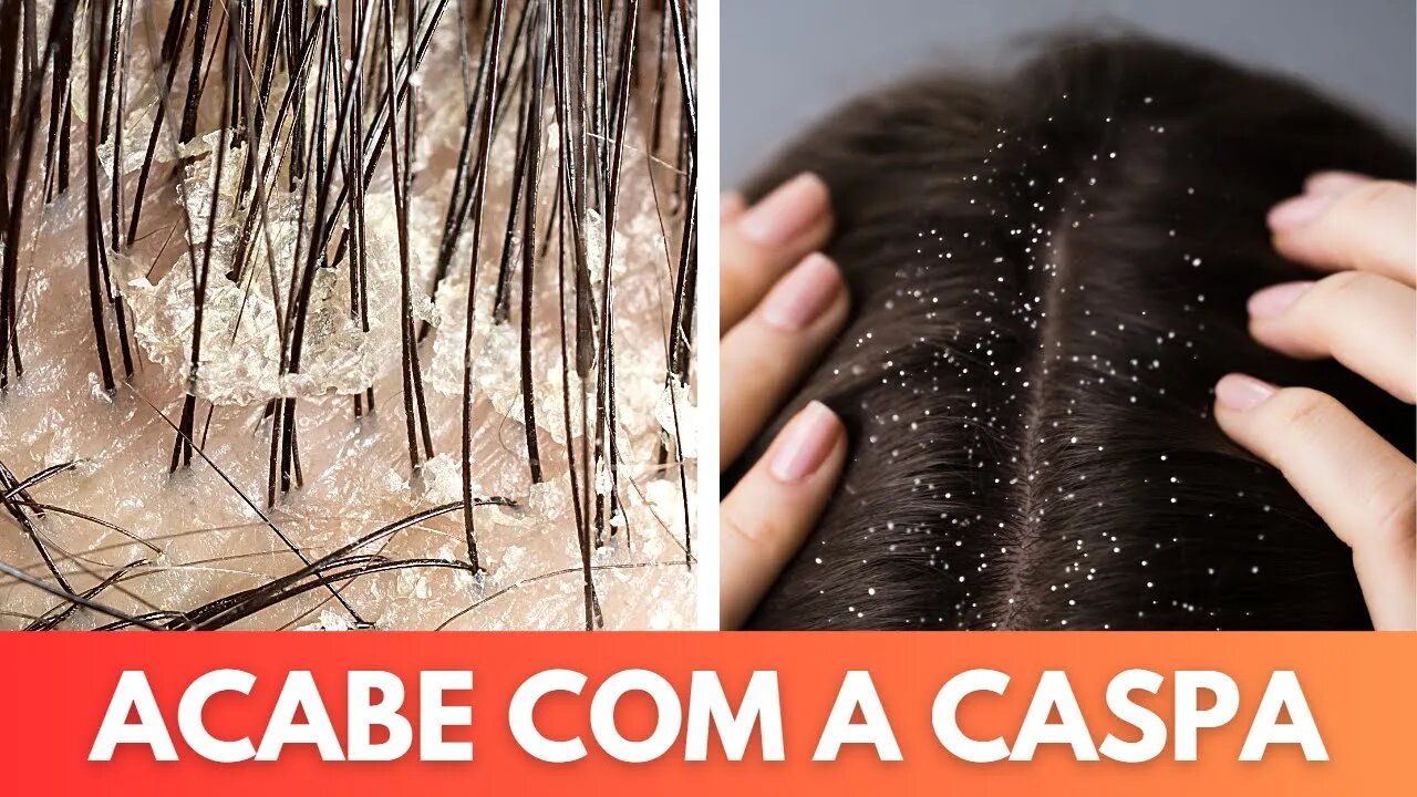 Os melhores truques naturais para dizer adeus à caspa de uma vez por todas!