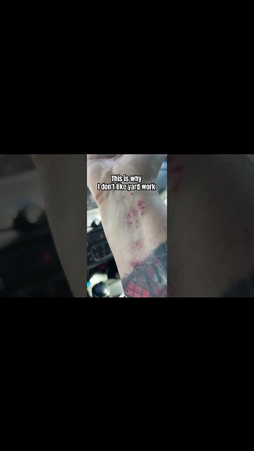 Poison Ivy Allergic Reaction is not Fun