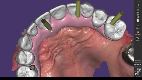 Exocad and screw hole meshes