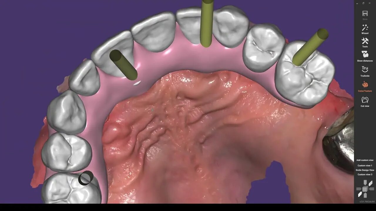 Exocad and screw hole meshes