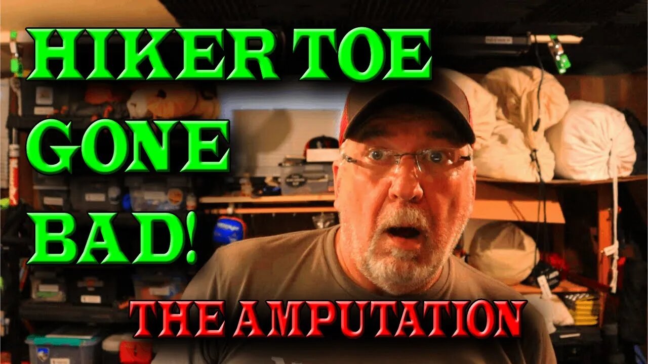 HIKER TOE GONE BAD | AMPUTATION | *GRAPHIC PICTURES*