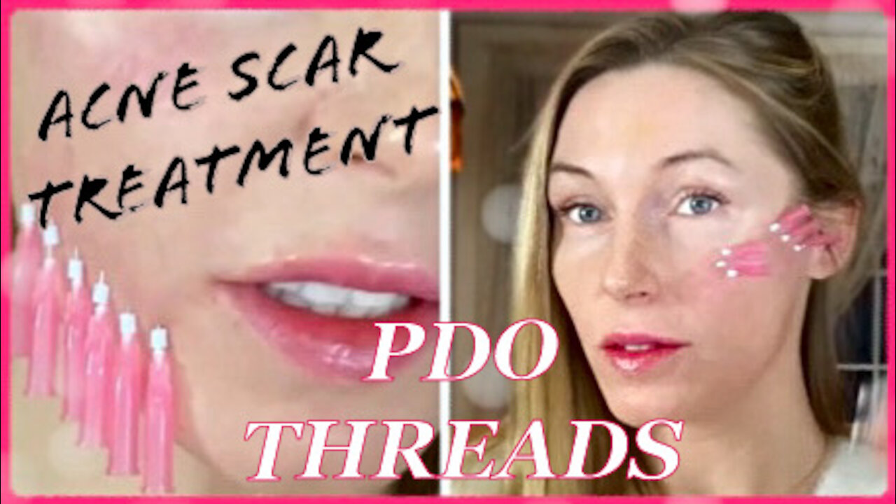 #PDOTHREADS #diypdothread #acnescartreament