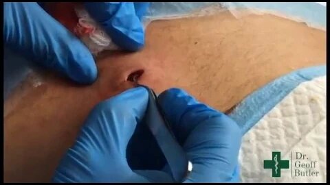 Removal of Epidermal cyst on the Lower Back