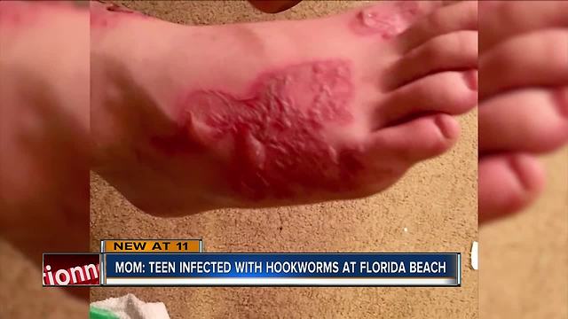 Teen infected with hookworms on Florida beach