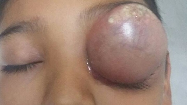 Removing pimple on the eye