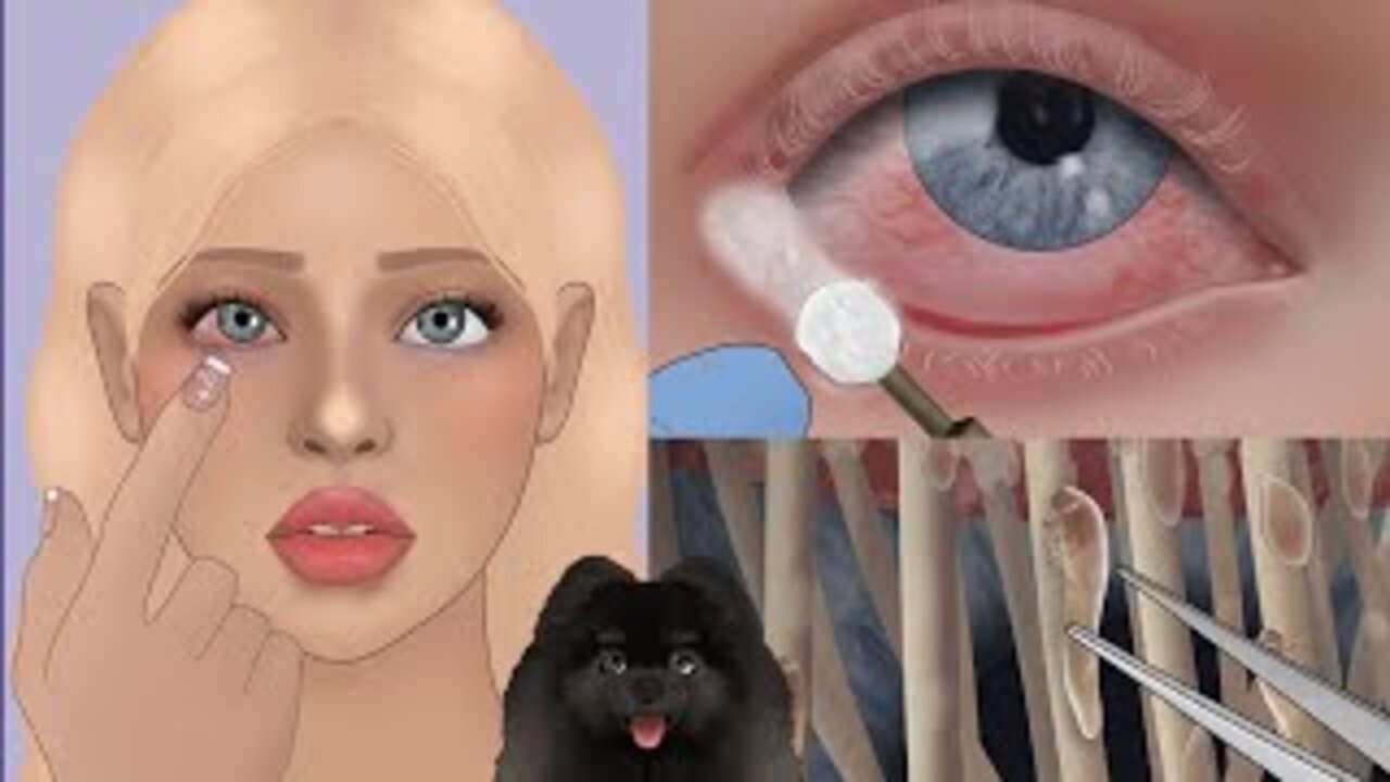 Eyelash mites treatment animation - satisfying sound - remove itchy annoying mites ASMR