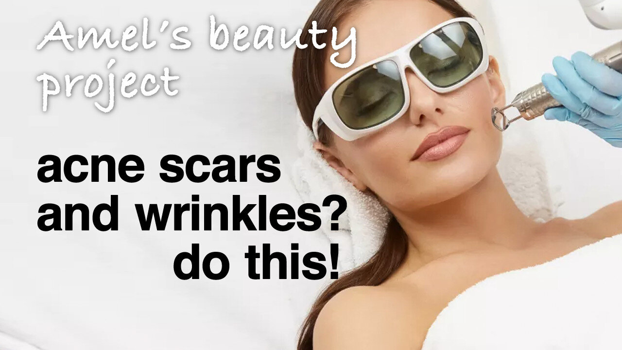 😎 ACNE SCARS And WRINKLES? | Do This! | CO2 Laser Rejuvenation Is The Answer