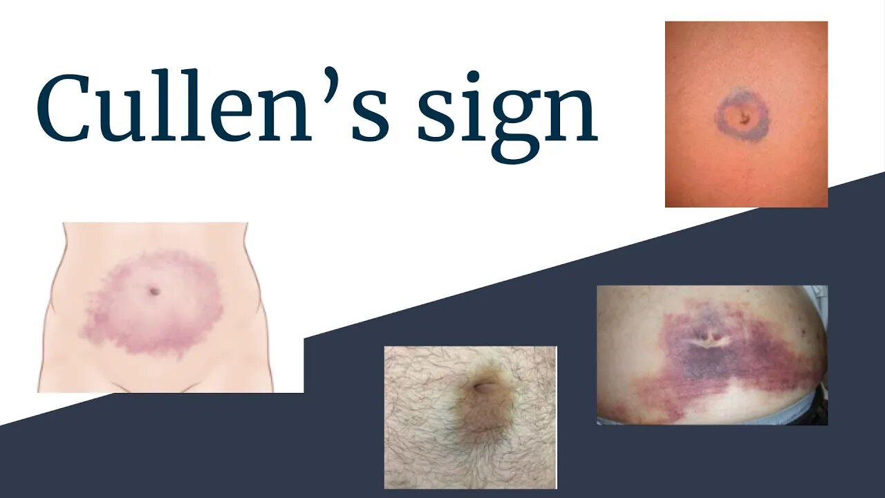 Understanding Cullen's Sign | Clinical Significance and Causes