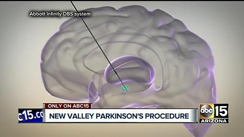 New procedure helping Valley Parkinson’s patients