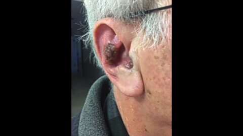 Ear Lesion Cured Using The Universal Antidote ClO2