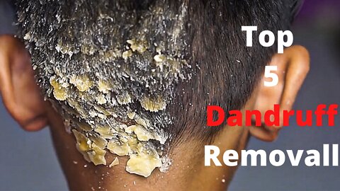 Top 5 Dandruff removals Big Flakes