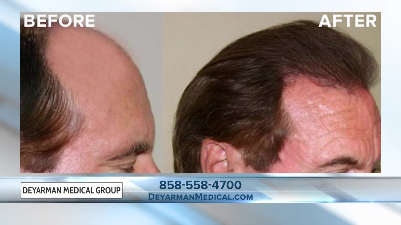 Dr. James Deyarman explains why stem cell treatments may work for you instead of hair transplants