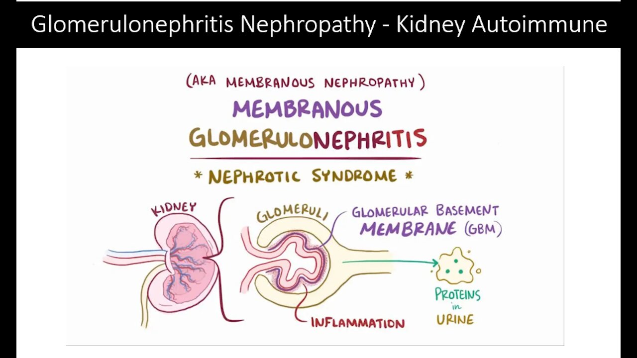 Kidney Autoimmune Glomerulonephritis Nephropathy