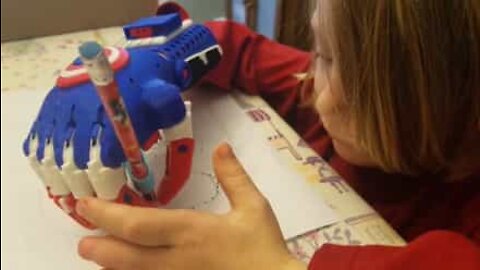 Crea protesi 3D per bambini con la stessa malformazione