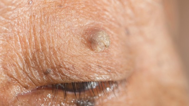 Doctor Shares Everything You Need to Know About Skin Tags