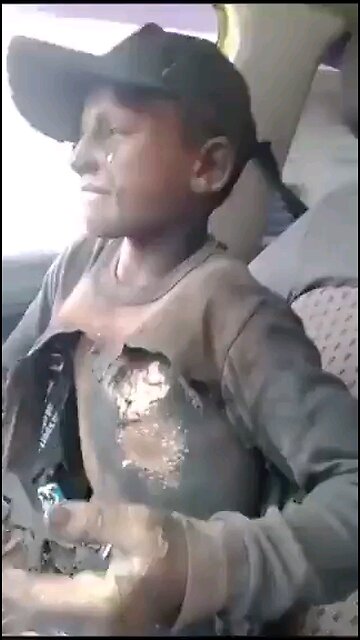 Israeli Settlers set fire to this young boy in the West Bank.