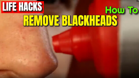 How To Remove Blackheads