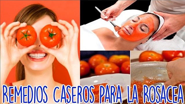 Remedios Caseros Para La Rosacea