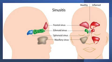 Sinusitis, Rhinosinusitis - Herbal remedies, nutritional supplements, TCM & Ayurveda