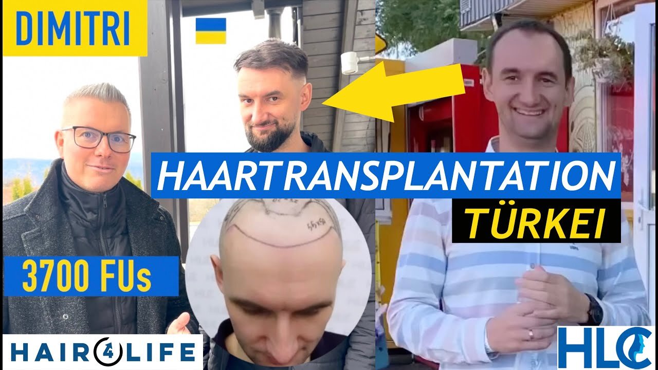 Haartransplantation Türkei: Dimitri`s OP auf eine Vorderkopf-Glatze | HLC