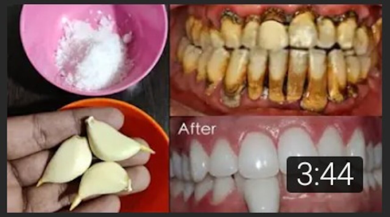 Teeth whitening at home in 3 minutes || How to naturally whiten your yellow teeth || 100% effective