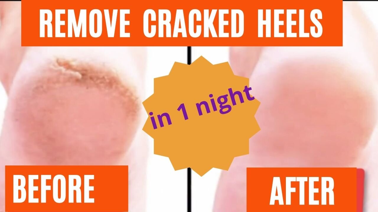 🌜 🍋 Get rid of cracked heels in one night 🍋