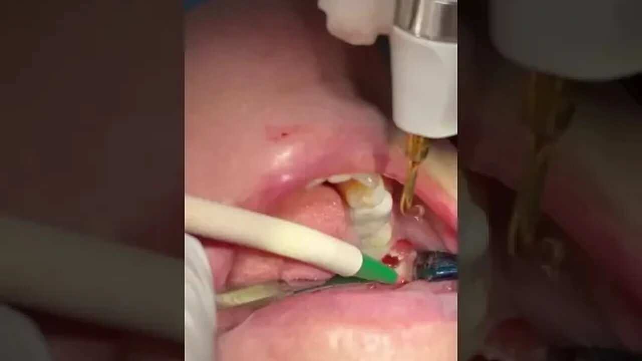 Jawbone of a patient suspected of having jawbone necrosis. Courtesy of Dr. Miguel Stanley, DDS