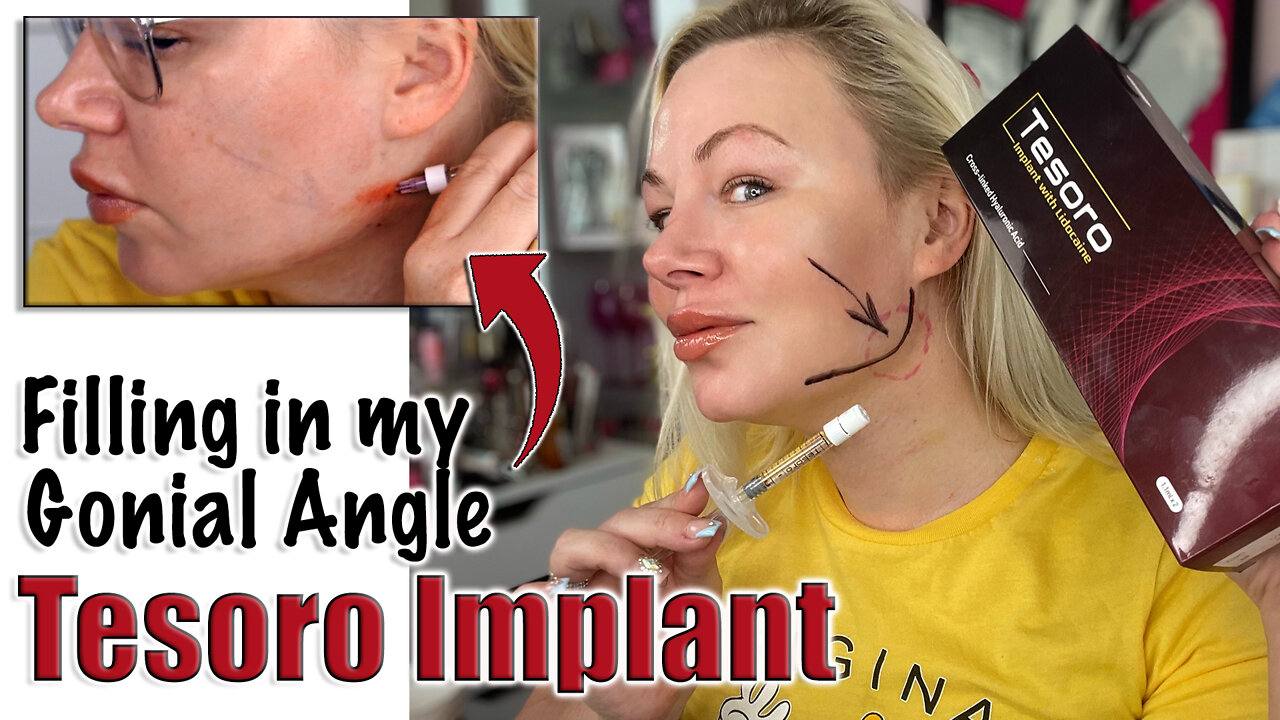 Filling in My Gonial Angle with Tesoro Implant Filler Acecosm.com | Code Jessica10 Saves you Money!