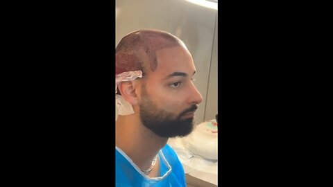 First Six Month Of My Turkey Hair Transplant