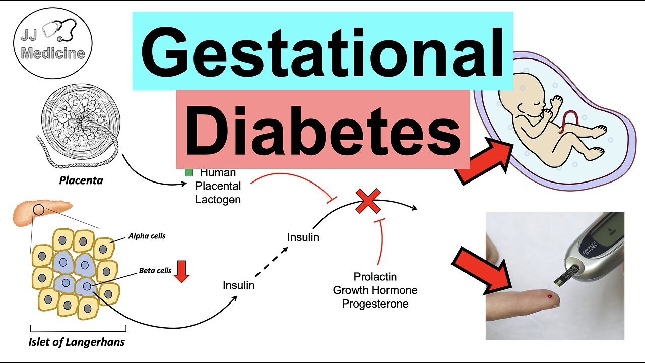 Gestational Diabetes (Pregnancy Diabetes) Risk Factors, Symptoms, Long-Term Effects, Treatment