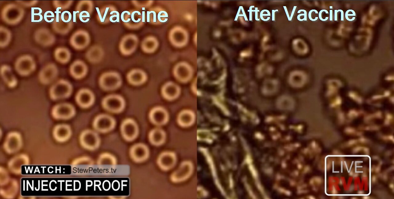 BREAKING DISCOVERY! What COVID Injections Do To Your BLOOD!