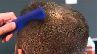 Hair loss related to working longer hours
