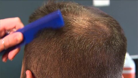 Hair loss related to working longer hours