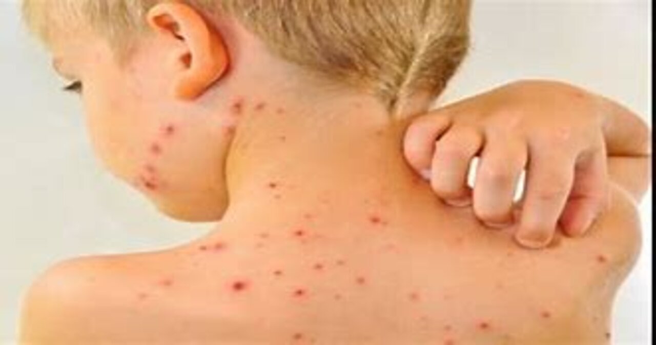Novo Virus Espalhando-se pelo mundo VARIOLA