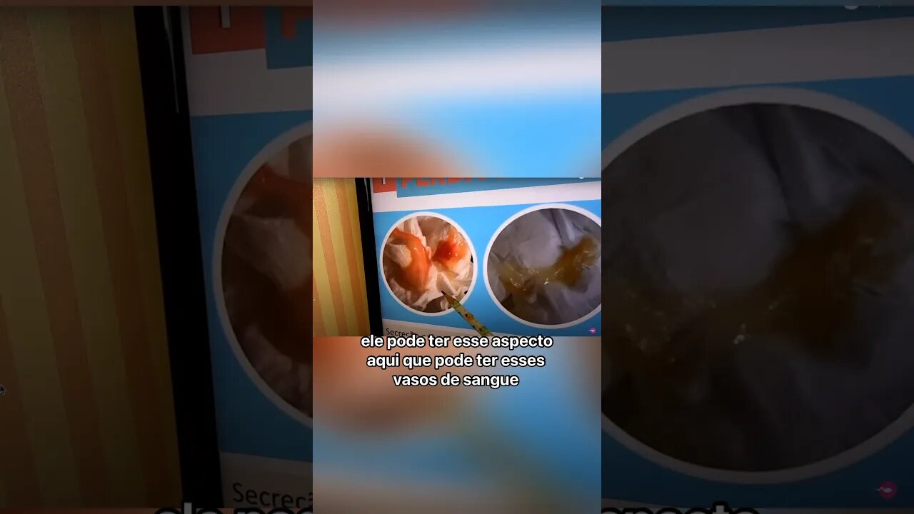 Como é a cor do tampão mucoso?