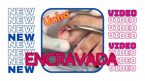 Unha ENCRAVADA devido a corte incorreto!!! #unhaencravada #podologia #nails #ingrown_toenail