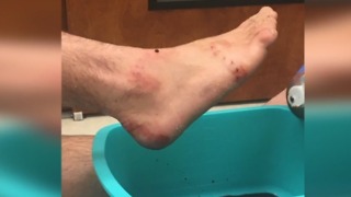 Lifeguard gets bitten by shark in Lantana Beach